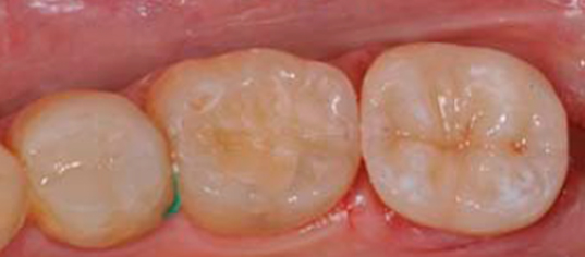 Intarsi dentali a Brescia ricostruzioni artificiali di parti di un dente  danneggiato