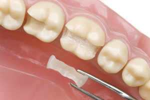 Intarsi dentali a Brescia ricostruzioni artificiali di parti di un dente  danneggiato